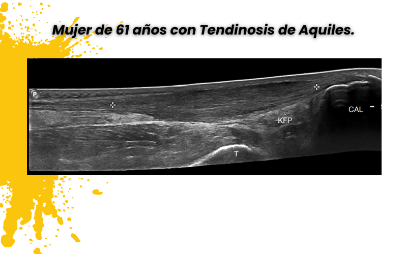 2. Tendon aquiles ecografia tempo formacion.png